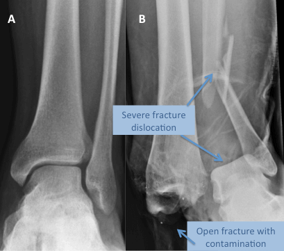 A - x-ray of a normal ankle, B - an x-ray of an open fracture dislocation of the ankle with contaminated wound. This patient is at high risk of developing osteomyelitis and post traumatic arthritis