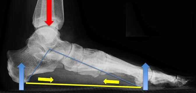 The plantar fascia (yellow line) prevents collapse of the foot arch by virtue of its anatomical orientation and tensile strength (yellow arrows), body weight (red arrow) ground reaction force (blue arrow) 