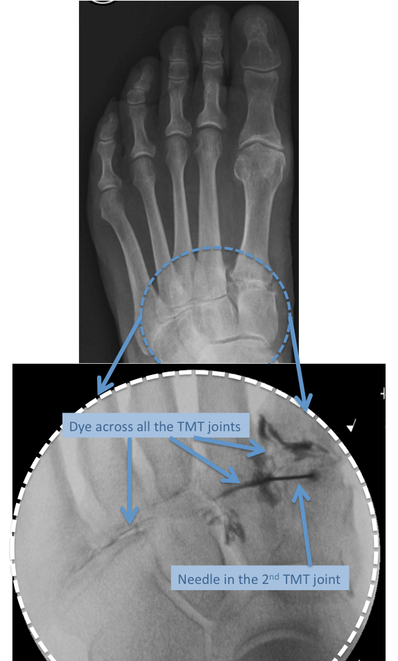 Radiographic images of arthritis in the left midfoot TMT 1 - 5 joints, treated with an image guided injection under x-ray control. Note the dye in the lower image indicating correct placement of needle