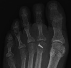 An x-ray showing surgical correction of the plantar plate