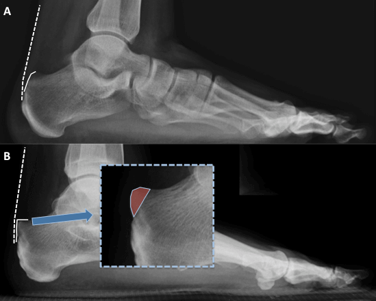 A - Normal x-ray of the foot and ankle; B - X-ray demonstrating a Haglund's deformity - note reduced space between Achilles tendon (dotted line) and back of the heel bone (solid white line) Haglund deformity in shaded red area in enlarged box
