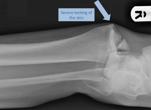 X-ray of a fracture dislocation of an ankle. Note how the skin is being stretched over the sharp edge of bone (blue arrow), left untreated the skin will breakdown and the patient will be at serious risk of developing osteomyelitis and ankle arthritis