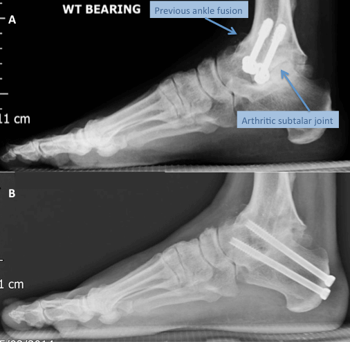 An x-ray of the foot showing a patient who developed subtalar arthritis after an ankle fusion and an x-ray showing as ubtalar fusion after surgey