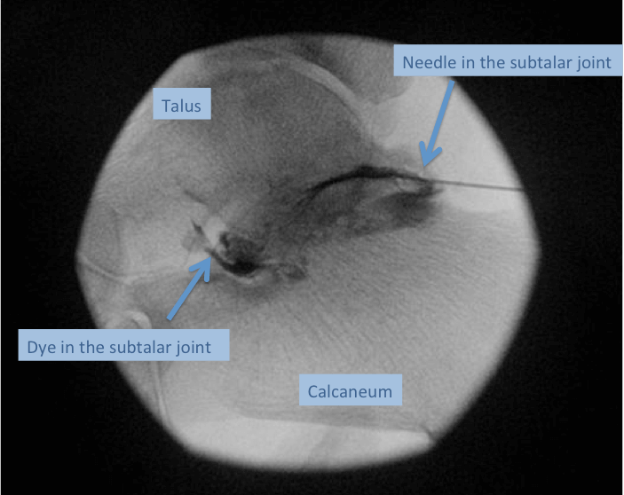 Intraoperative x-ray showing correct placement of needle in the subtalar joint (confirmed with radiopaque dye)