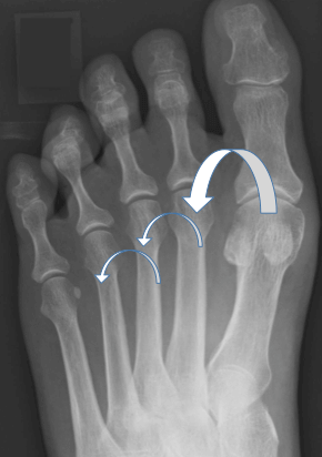 Illustration of how load is transferred from the big toe to the lesser toes in transfer metatarsalgia
