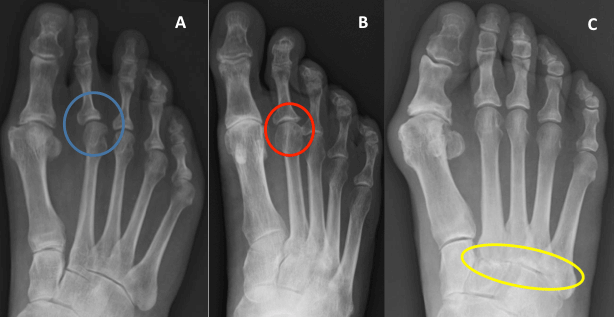 Consequence of untreated 1st MTP joint arthritis A - 2nd MTP joint instability/synovitis, B - 2nd MTP joint arthritis, C - Midfoot arthritis