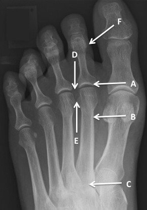 Sites of problems (pathology) as a result of transfer metatarsalgia. A - 2nd MTP joint synovitis, B - 2nd metatarsal stress lesion/stress fracture, C - 2nd TMT joint arthritis, D - intermetatarsal bursitis, E - Morton's neuroma, F - toe deformity