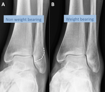 A - x-ray of the ankle demonstrating a fracture of the lateral malleolus, B - on weight bearing views there is no displacement of the bones indicating this is a stable fracture and can be managed non-operatively