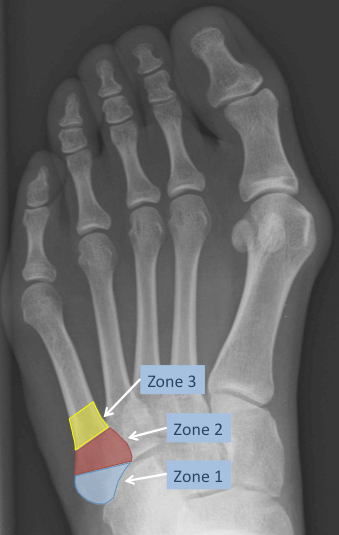 X-ray of the foot demonstrating the zones of injury in base of 5th metatarsal fractures