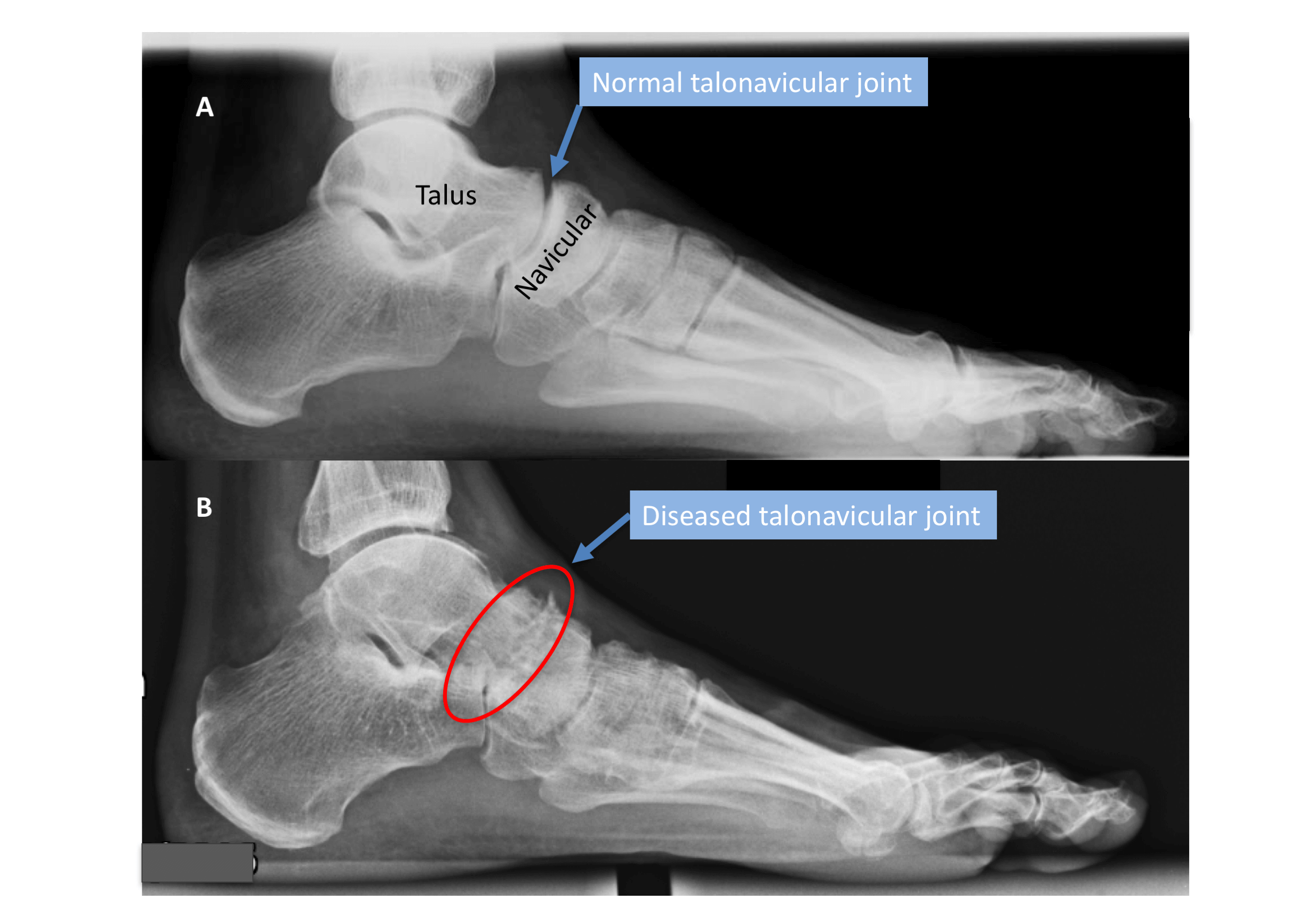 A - Normal radiograph of the foot lateral view B - Talonavicular arthritis