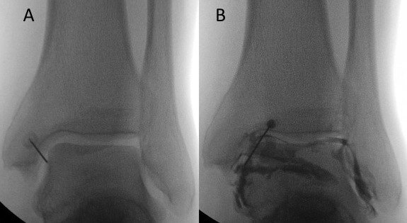 A - Placement of fine needle in ankle joint B - Radio-opaque dye confirms needle is in the joint