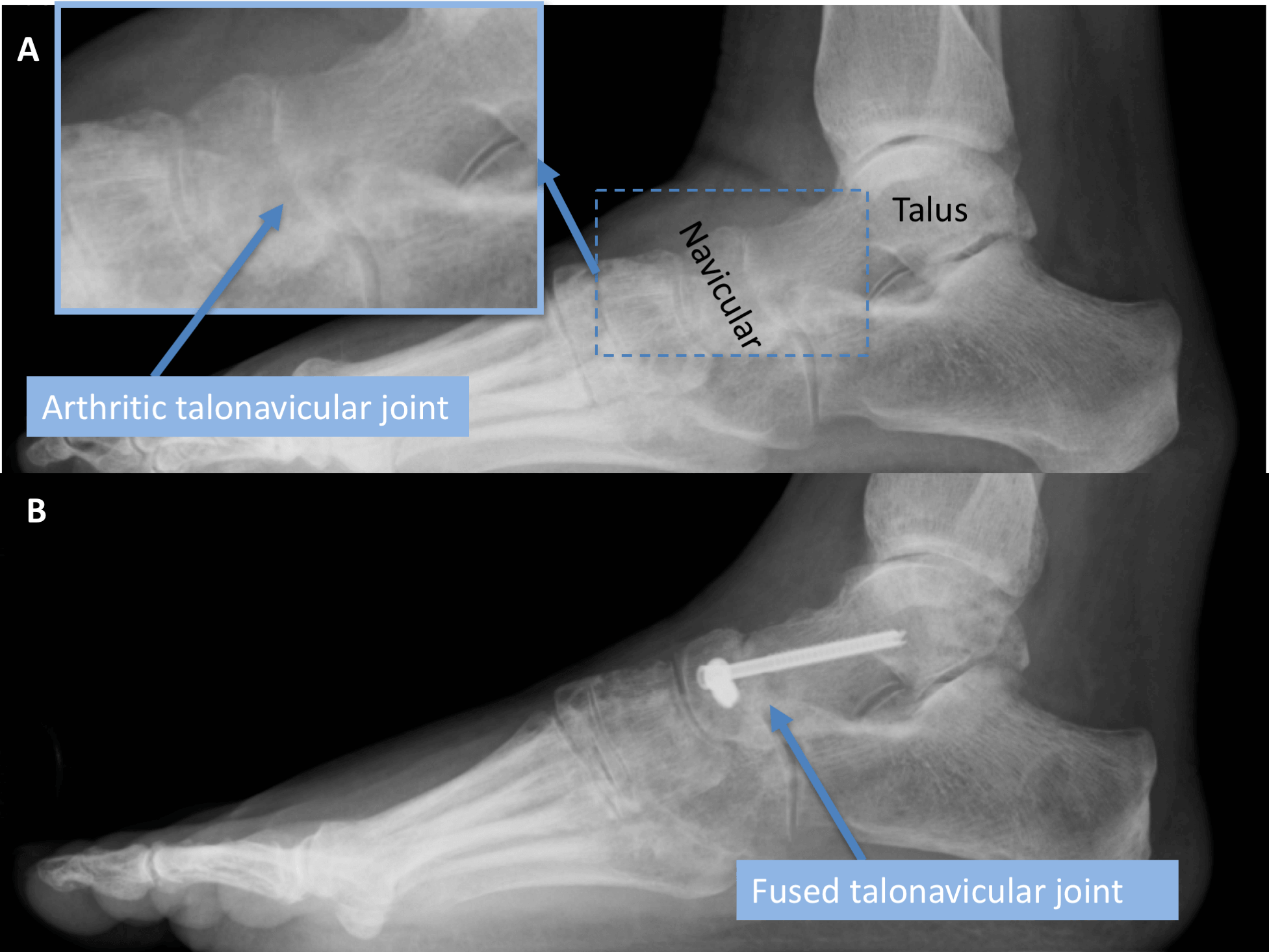A - Lateral radiograph of a foot pre operatively demonstrating severe bone on bone talonavicular arthritis B - Post operative radiograph at 6 weeks with successful fusion at the talonavicular joint
