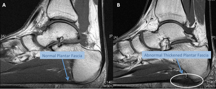MRI scans of the hindfoot showing a normal plantar fascia and an abnormal plantar fascia