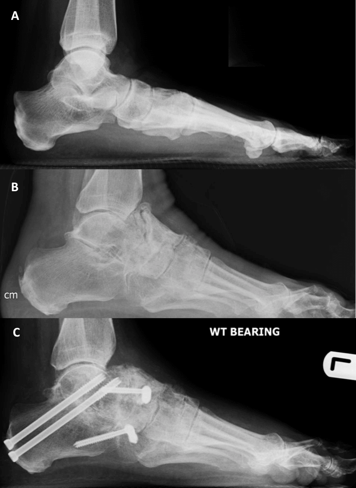 A - Normal foot &amp; ankle radiograph B - patient with severe talonavicular arthritis and subtalar joint involvment C - post triple joint fusion - made made an excellent recovery with increased range of motion, complete relief of pain and full function
