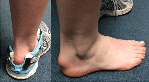 Clinical picture of the foot in a patient with severe superficial calcaneal bursitis