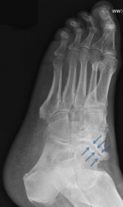 Plain radiograph of the foot showing talonavicular joint arthritis (blue arrows)