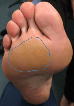 Clinical picture demonstrating diffuse plantar callosity of the forefoot