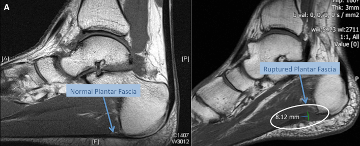 MRI's of the hindfoot showing a normal plantar fascia and a plantar fascia rupture