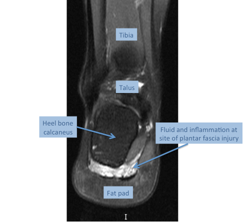 MRI of the heel viewd from the front demonstrating injury to the plantar fascia origin